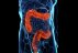 Hlavní obrázek - Monocentrická retrospektívna analýza asociácie hidradenitis suppurativa a chronických zápalových ochorení čreva