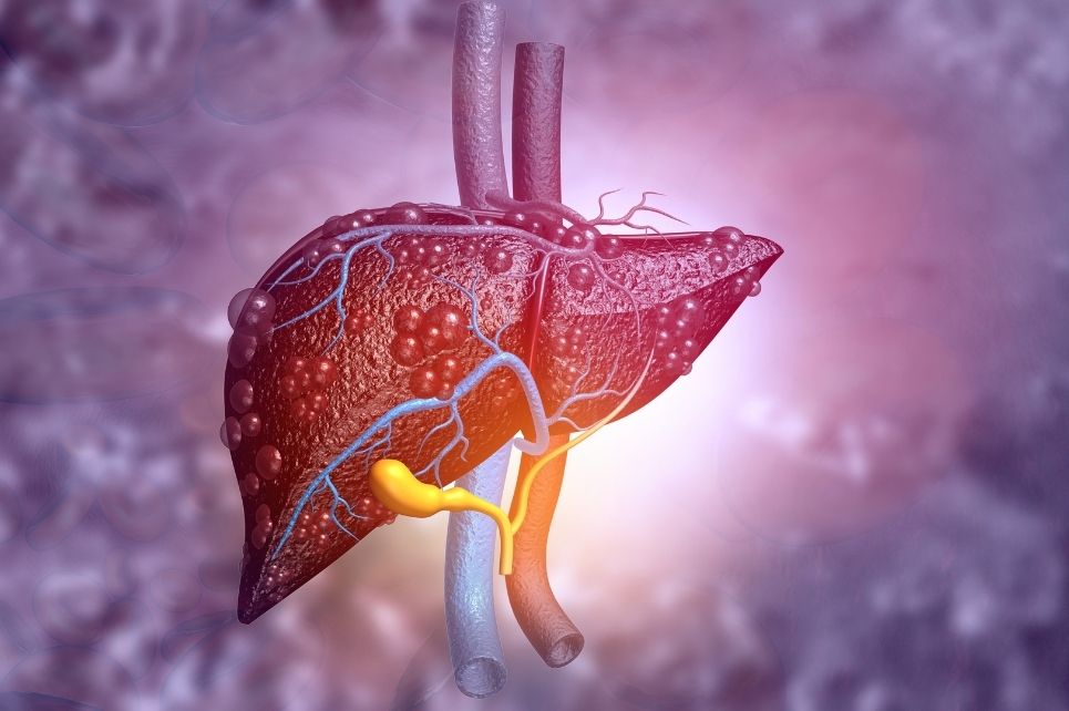 Hlavní obrázek - Poškodenie pečene po užívaní anabolických steroidov za účelom rastu svalovej hmoty – skúsenosti z hepatologického pracoviska
