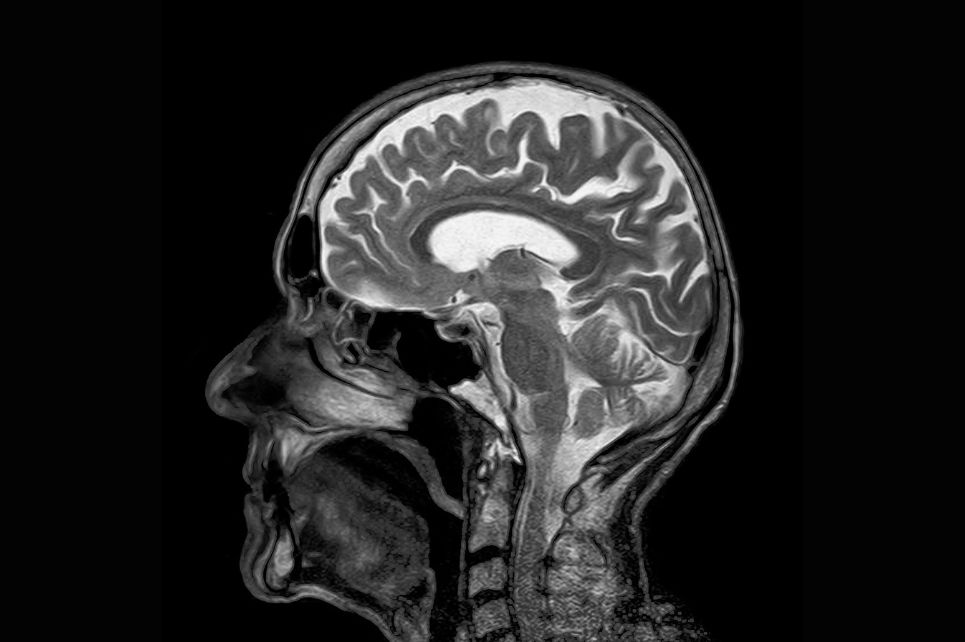 Hlavní obrázek - Bickerstaff brainstem encephalitis and Guillain-Barré syndrome overlap